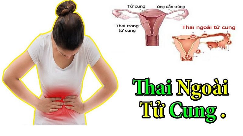 Đau Bụng Dữ Dội có nguy cơ thai ngoài tử cung