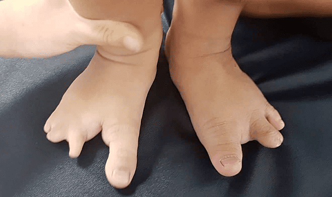 dị tật tay chân