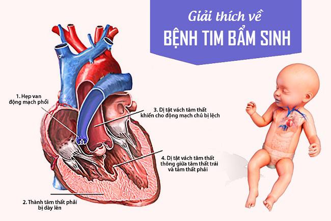 dị tât tim bẩm sinh