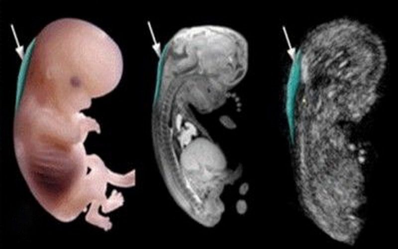 siêu âm giúp phát hiện dị tật sau gáy