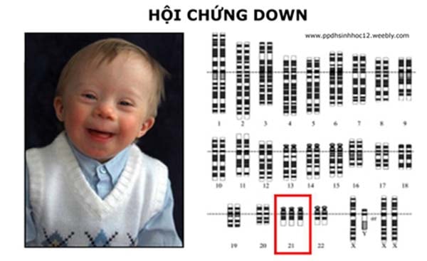 hội chứng Down (Trisomy 21)