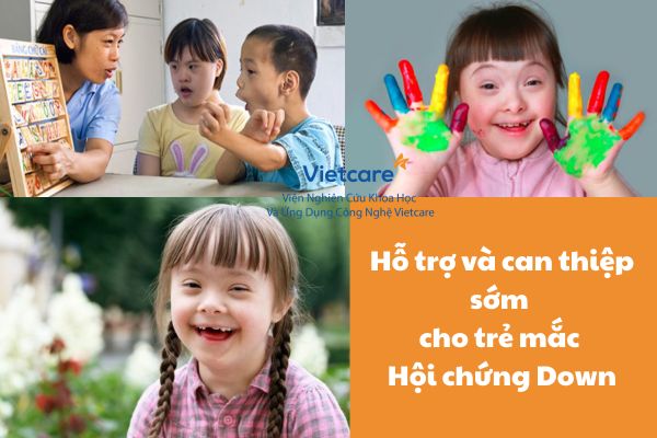 Hỗ trợ và can thiệp sớm cho trẻ mắc Hội chứng Down