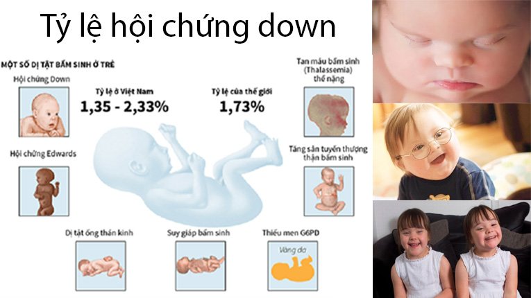 Tỉ lệ hội chứng Down