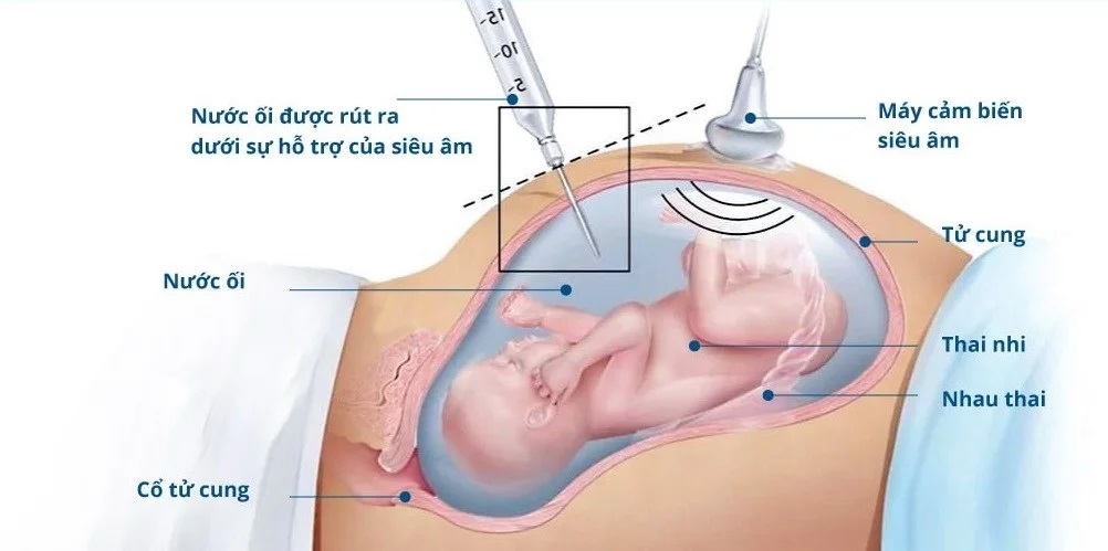 Phương pháp xâm lấn: Chọc ối và sinh thiết gai nhau