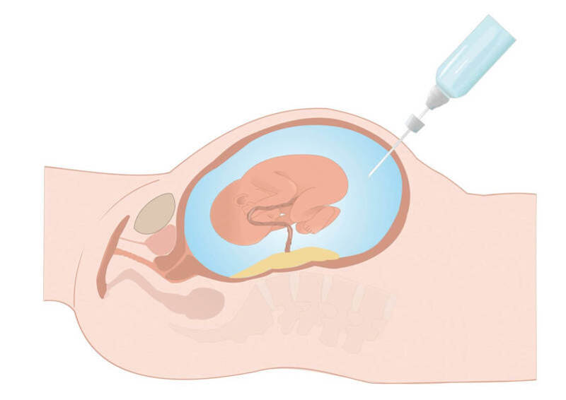 chọc ối xét nghiêm adn