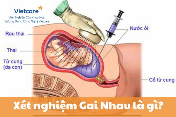 Xét nghiệm Gai Nhau là gì?